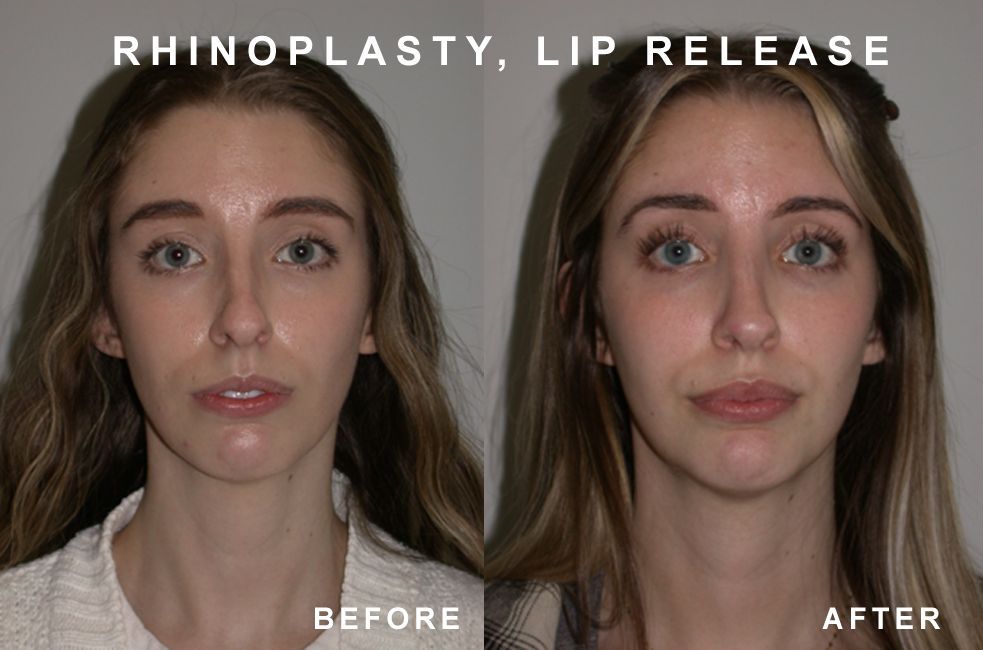 Before and after photos showing rhinoplasty and lip release. A woman's nose appears smaller and lips fuller after surgery.