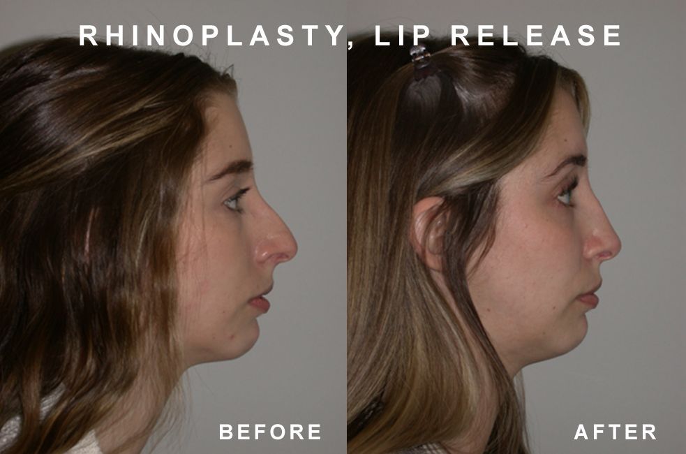 Side-by-side comparison of a person's profile before and after rhinoplasty and lip release; the after image shows a reshaped nose and lip.