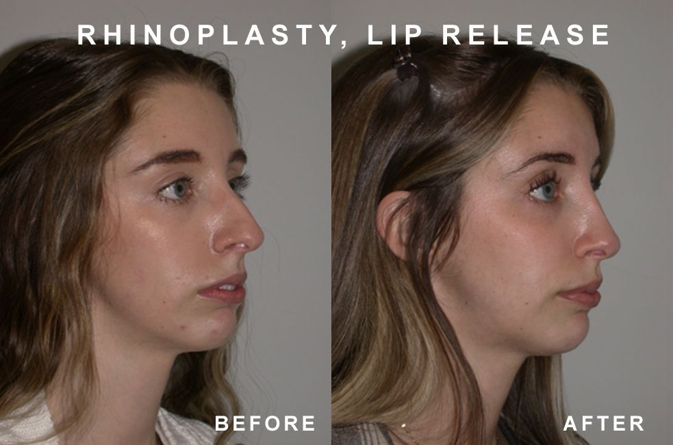 Side-by-side comparison: Before and after rhinoplasty and lip release. Woman with nose and lip alterations.