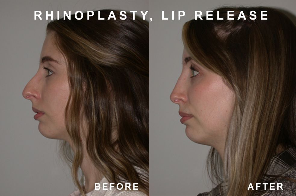 Side-by-side comparison of a person's profile before and after rhinoplasty and lip release. The 