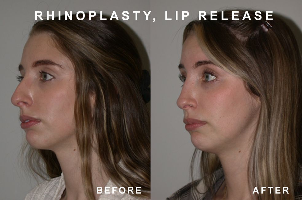 Side-by-side comparison of a person's profile: before and after rhinoplasty and lip release.