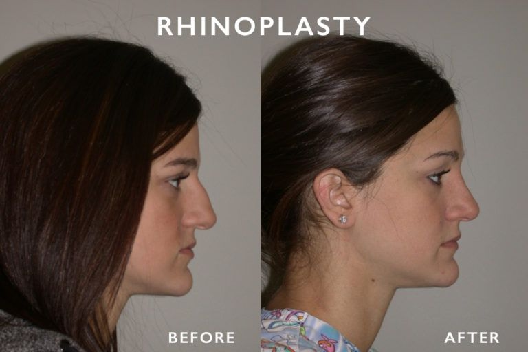 Before and after side profile of a woman; a rhinoplasty is visible in the change to the nose.