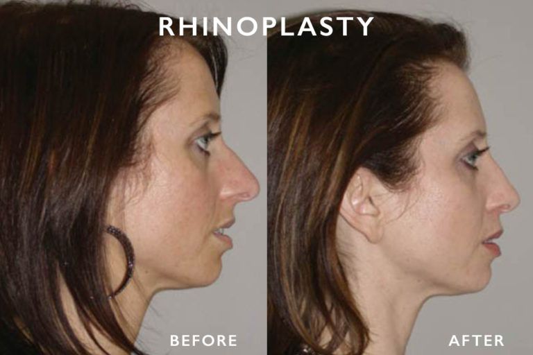 Before and after rhinoplasty: Profile of a woman with a reshaped nose; a narrower, straighter bridge.