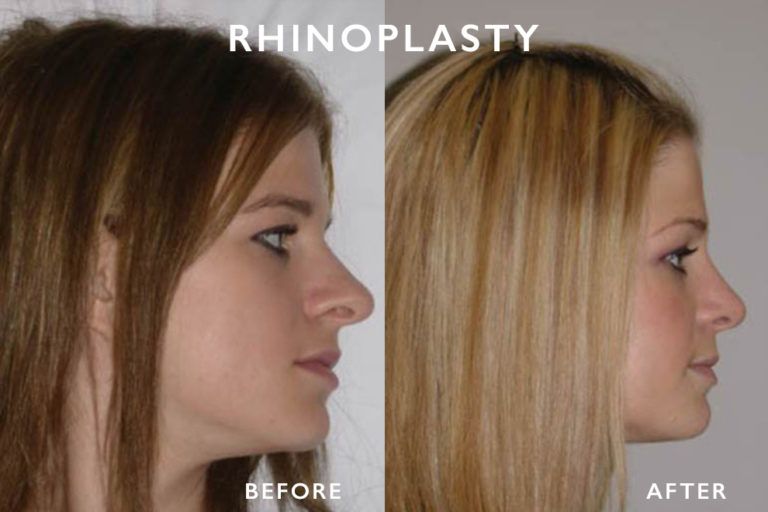 Before and after photos showing a woman's profile, illustrating rhinoplasty results; nose is straighter after surgery.