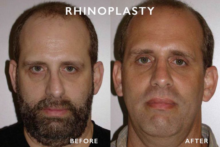 Before and after rhinoplasty: man with beard, then without, showing nose reshaping.
