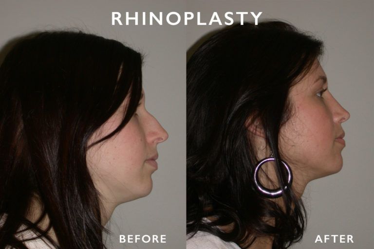 Side-by-side view shows a woman's profile before and after rhinoplasty (nose surgery).