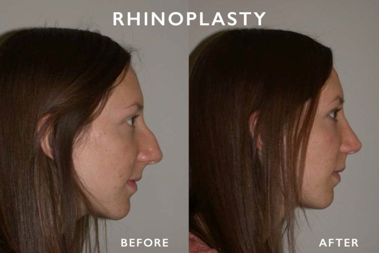 Before and after profile views of a woman's nose, illustrating rhinoplasty results.