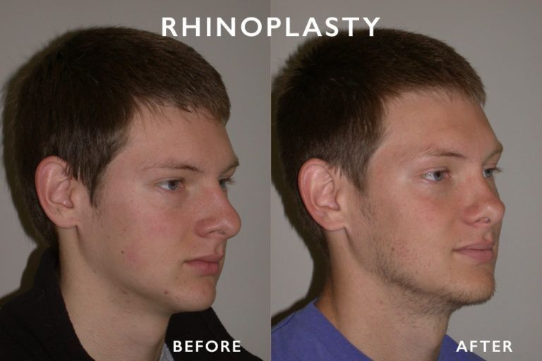 Side-by-side photos of a man; left 