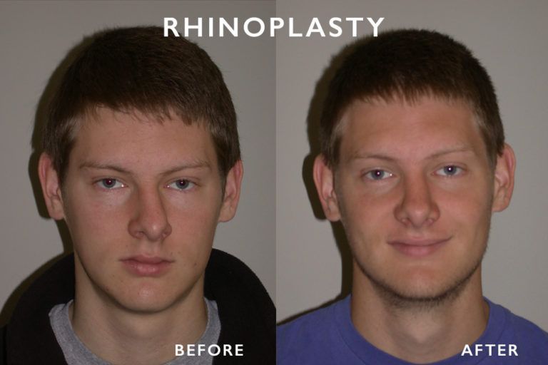 Before and after rhinoplasty photos of a man's nose, showing a change in shape.