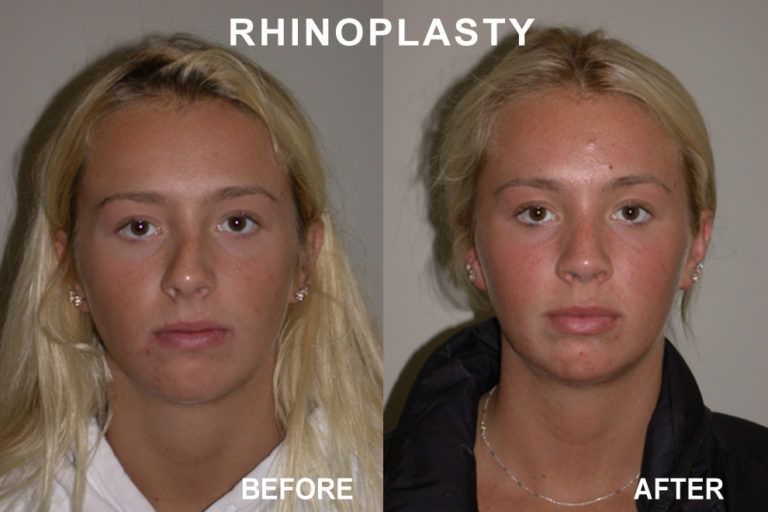 Side-by-side photos of a nose before and after rhinoplasty surgery, on a person with fair skin.