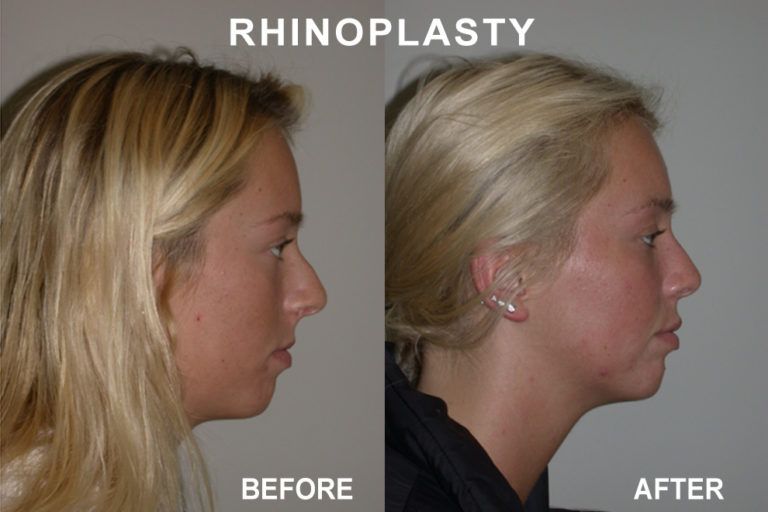 Side-by-side photos of a woman before and after rhinoplasty. The 