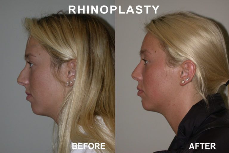 Side-by-side photos of a woman before and after rhinoplasty; the 