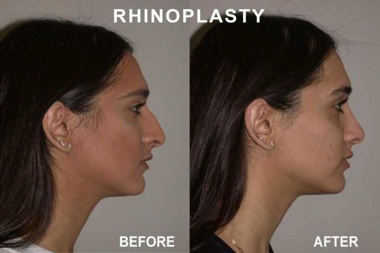Side-by-side comparison of a person's profile before and after rhinoplasty (nose surgery).