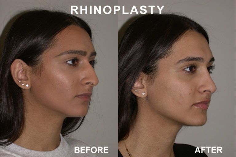 Before and after profile views of a woman's nose, comparing results of a rhinoplasty.