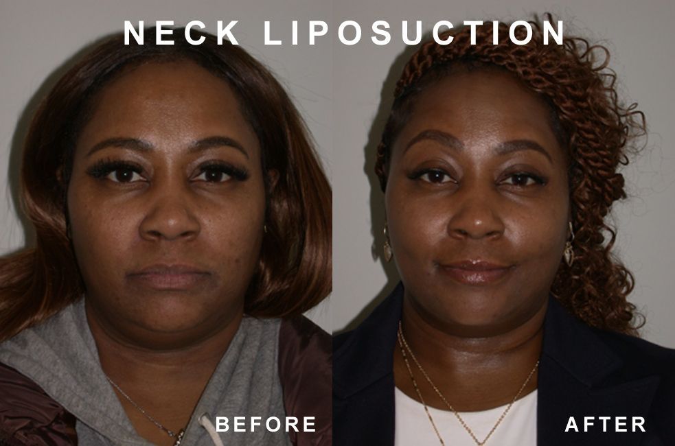 Before and after photos of a person's neck. The 