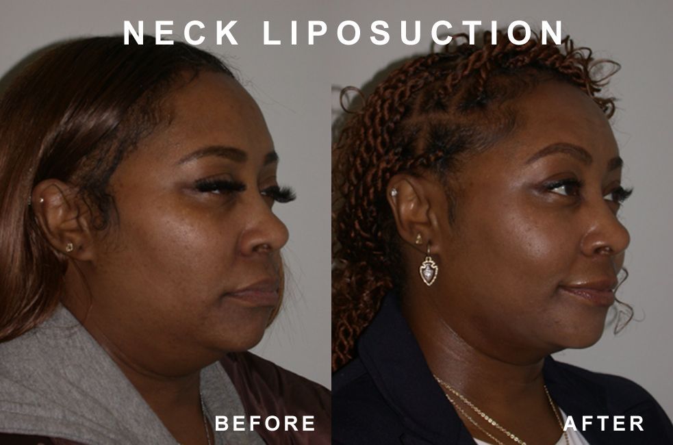 Before-and-after photos of a woman's neck lipo, showing a reduction in neck fullness post-surgery.