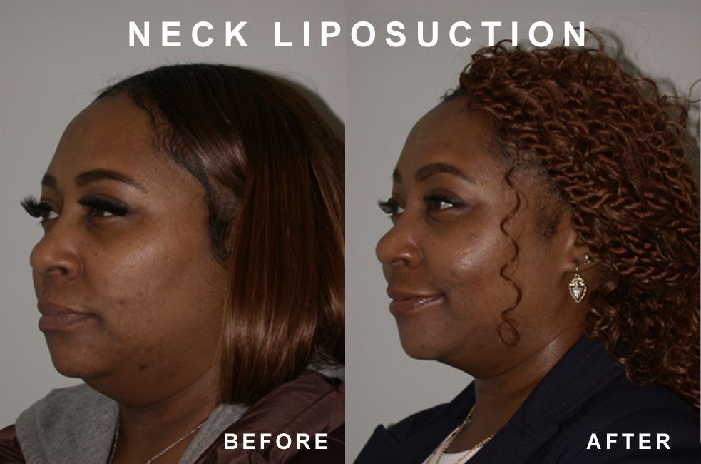 Neck liposuction before and after comparison; reduced fat in neck area.
