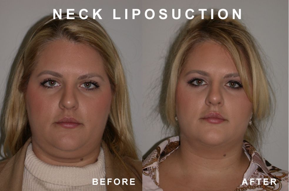 Before and after photos of a person's neck. Before, a full neck. After, reduced fat.