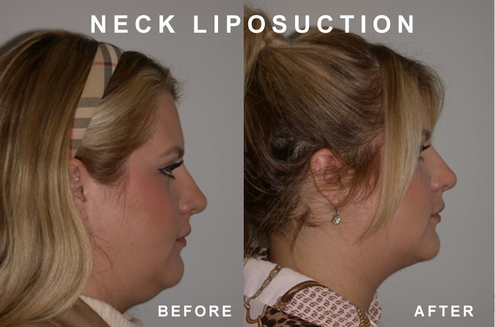 Side-by-side comparison: Before and after neck liposuction, showing reduced fat under the chin.
