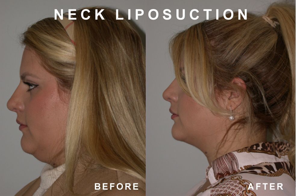Side-by-side comparison of woman's neck, before and after neck liposuction. The 