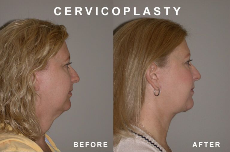 Before and after profiles of a woman's neck after a cervicoplasty, demonstrating reduced sagging.