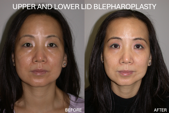Before and after photos showing a woman's face, upper and lower eyelids. The 