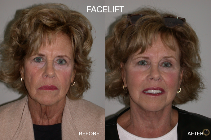 Side-by-side photos of a woman. Before: wrinkles, sagging skin. After: smoother skin, lifted appearance. Side-by-side photos of a woman. Before: wrinkles, sagging skin. After: smoother skin, lifted appearance.