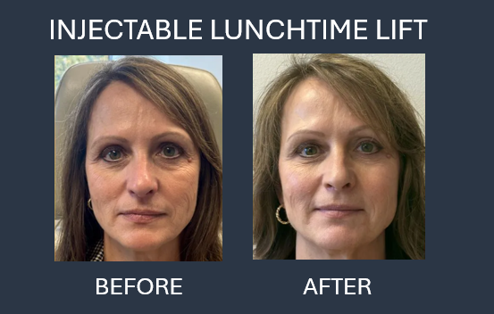 Before and after photos of a woman's face, showing the effects of an injectable facelift.