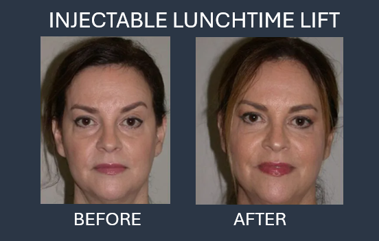Before-and-after facial comparison: woman's face, showing changes from 