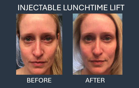 Before and after photos showing skin rejuvenation via 