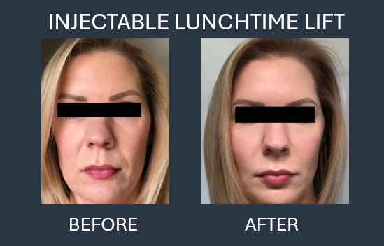 Before and after facial photo comparison, showcasing the results of an injectable lift.
