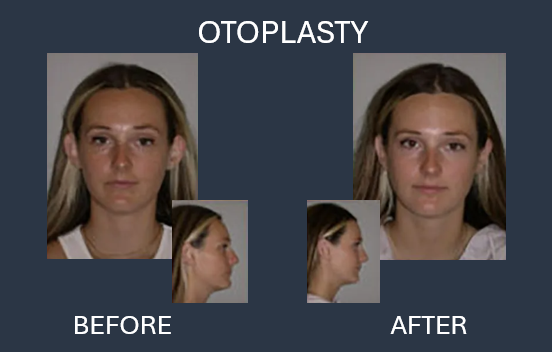 Before and after otoplasty results: Woman with prominent ears before, smaller ears after.