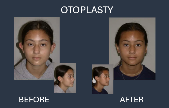 Before and after photos showing a person's ears before and after otoplasty.