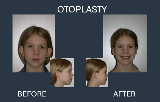 Before and after otoplasty: a child's ears protrude before, and are closer to the head after surgery.