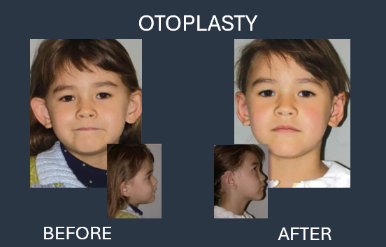 Comparison of child's ears before and after otoplasty. Before: Ears protrude. After: Ears closer to head.