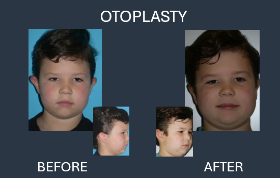 Before-and-after photos of a child's ears. Before: ears protrude. After: ears appear closer to the head.