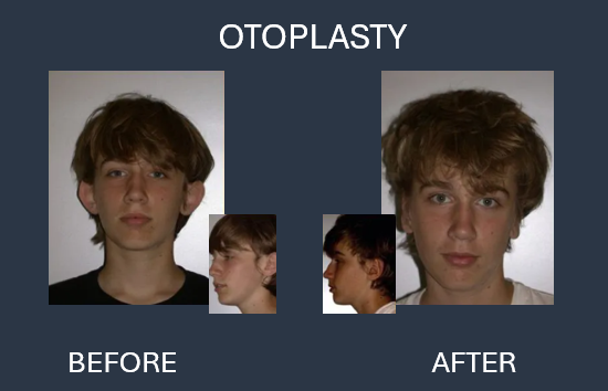 Before and after otoplasty: a person's ears protrude before the surgery, then are closer to the head afterward.