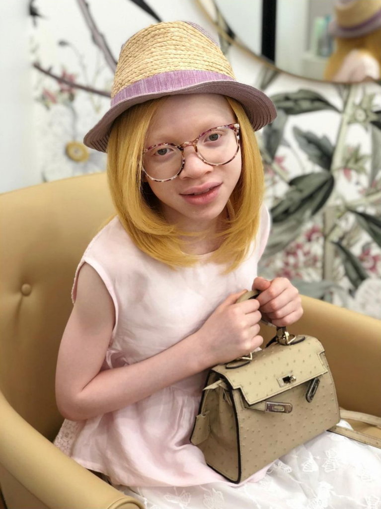 Jeune personne atteinte d'albinisme portant un chapeau de paille, tenant un sac à main et assise sur une chaise.