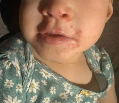 Baby with a rash around the mouth and nose, wearing a floral-patterned shirt.