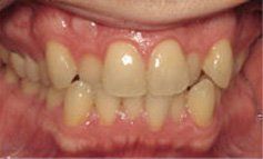Discolored Crowns - Before - Village Family Dental Associates