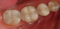 Discolored Crowns - After - Village Family Dental Associates