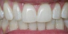 Discolored Crowns - After - Village Family Dental Associates
