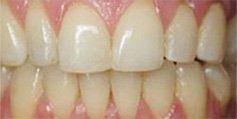 Discolored Crowns - Before - Village Family Dental Associates