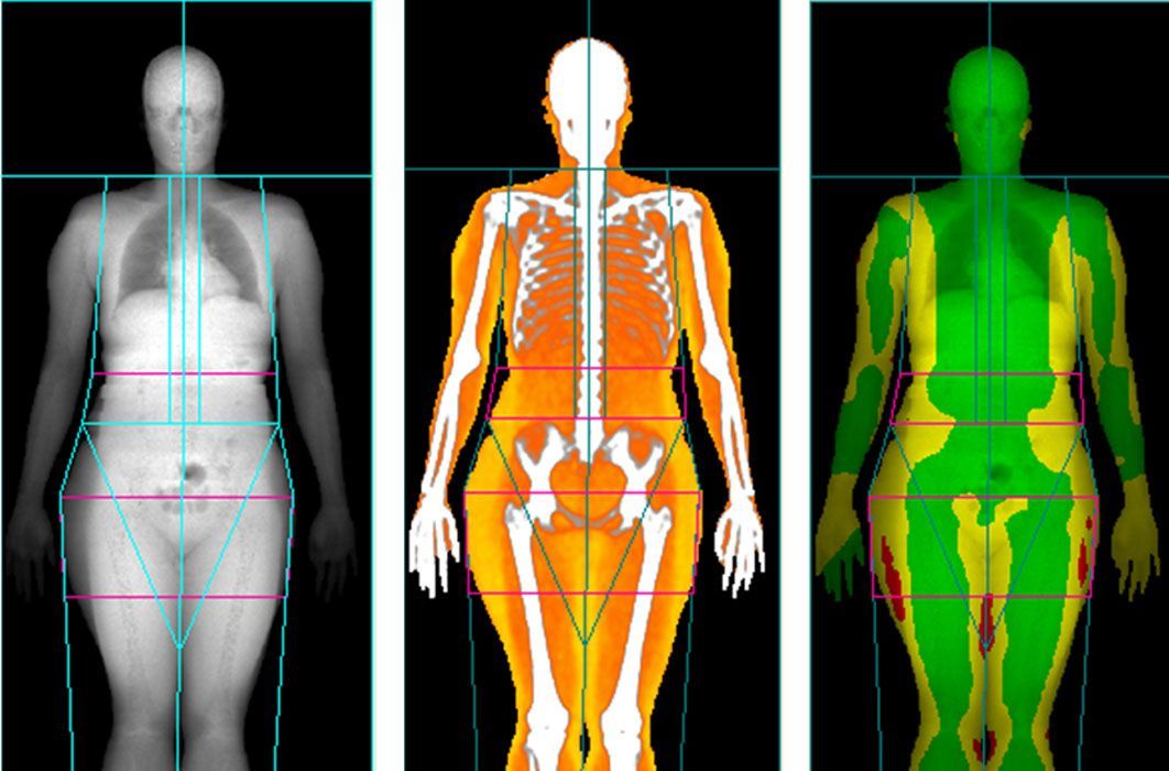 A woman 's skeleton is shown in three different colors.