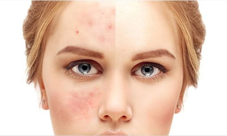 prima e dopo trattamento dell'acne