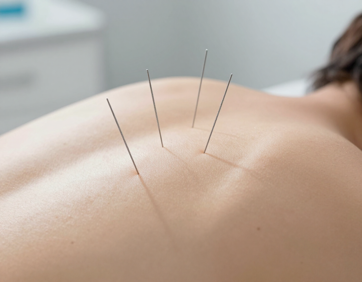 Dry needling needles placed in upper back trigger points