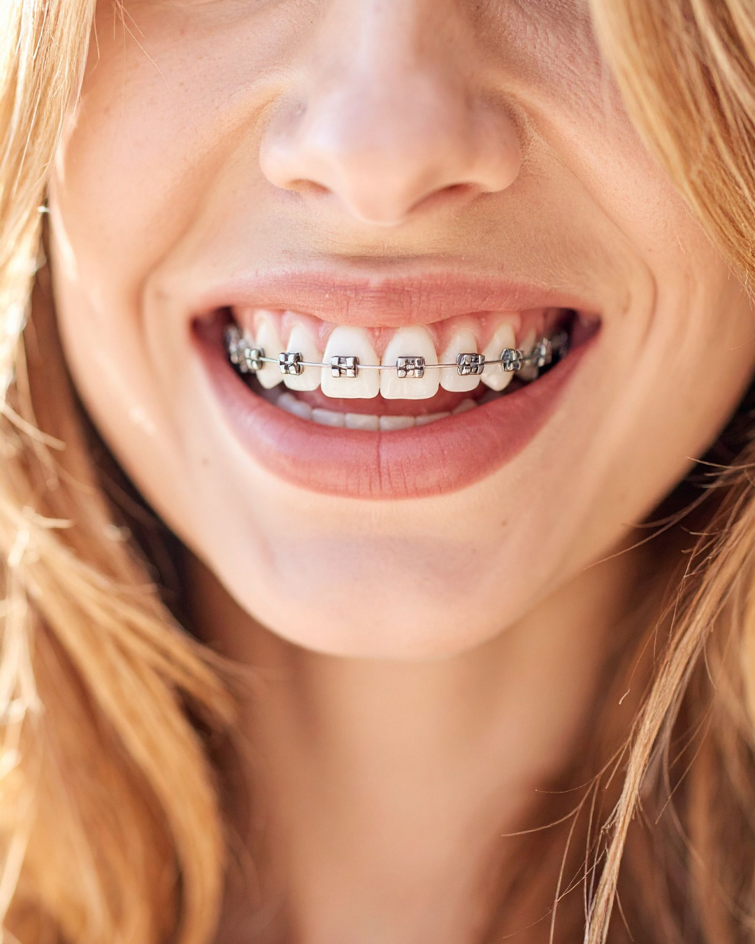 Gros plan sur une personne souriante, montrant des dents avec des appareils dentaires métalliques et des bagues fixées