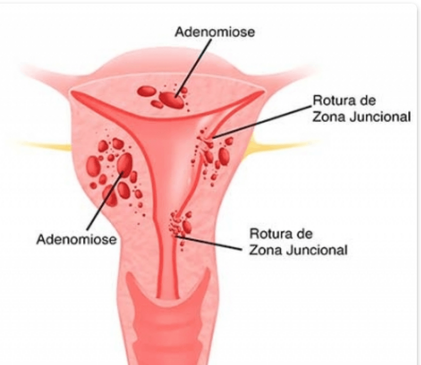 adenomiose-e-cancer-dra-graziele-cervantes-ginecologista-sao-paulo