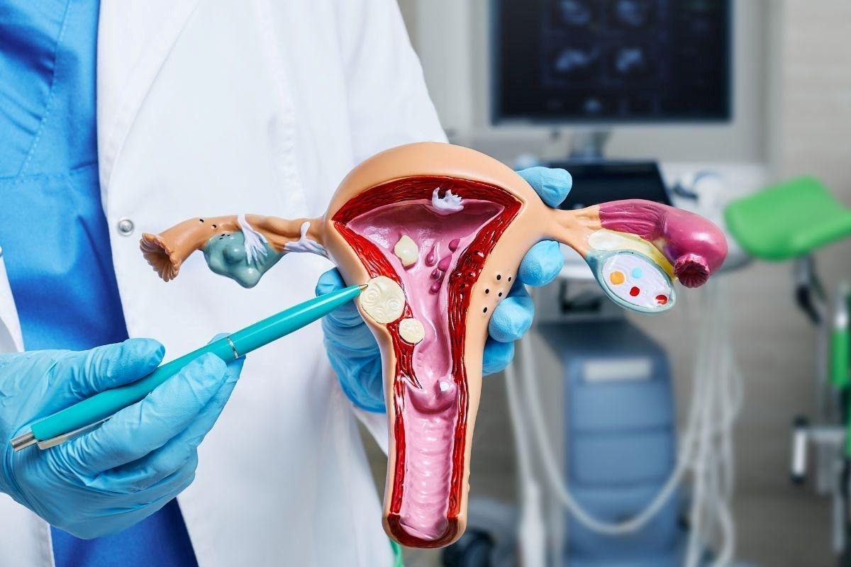 Cirurgia robótica para miomas: vantagens, recuperação e segurança