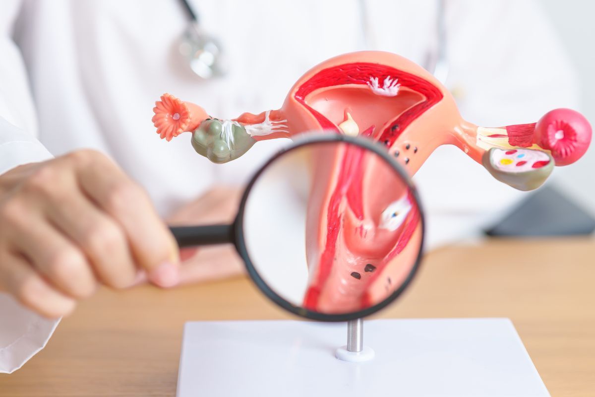 Endometriose profunda: quando operar é a melhor escolha
